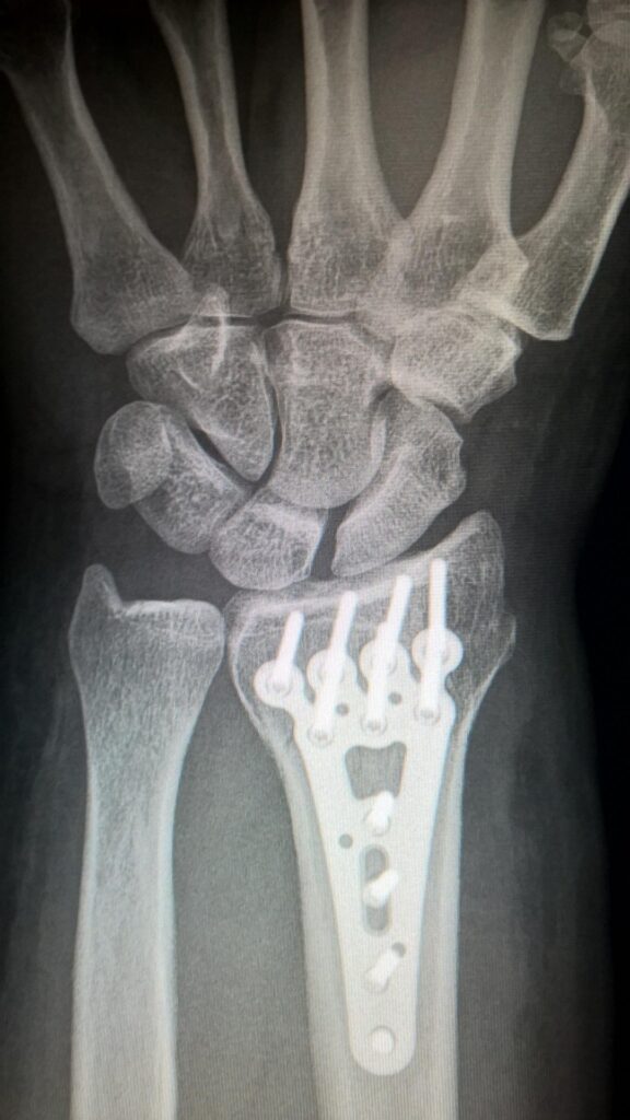 christophmeinersmann-broken-arm-2117980_1920
