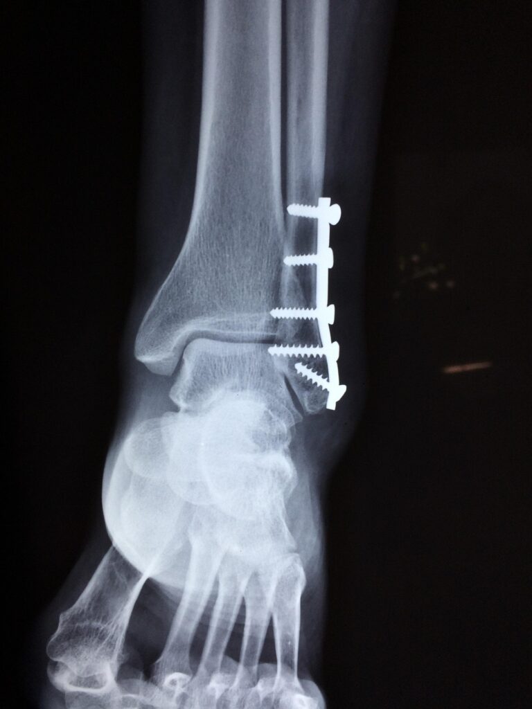 taokinesis-ankle-2253057_1920
